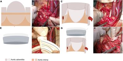 The short-term efficacy of adventitial inversion with graft eversion anastomosis for the reconstruction of the aortic sinus in the root treatment of aortic dissection